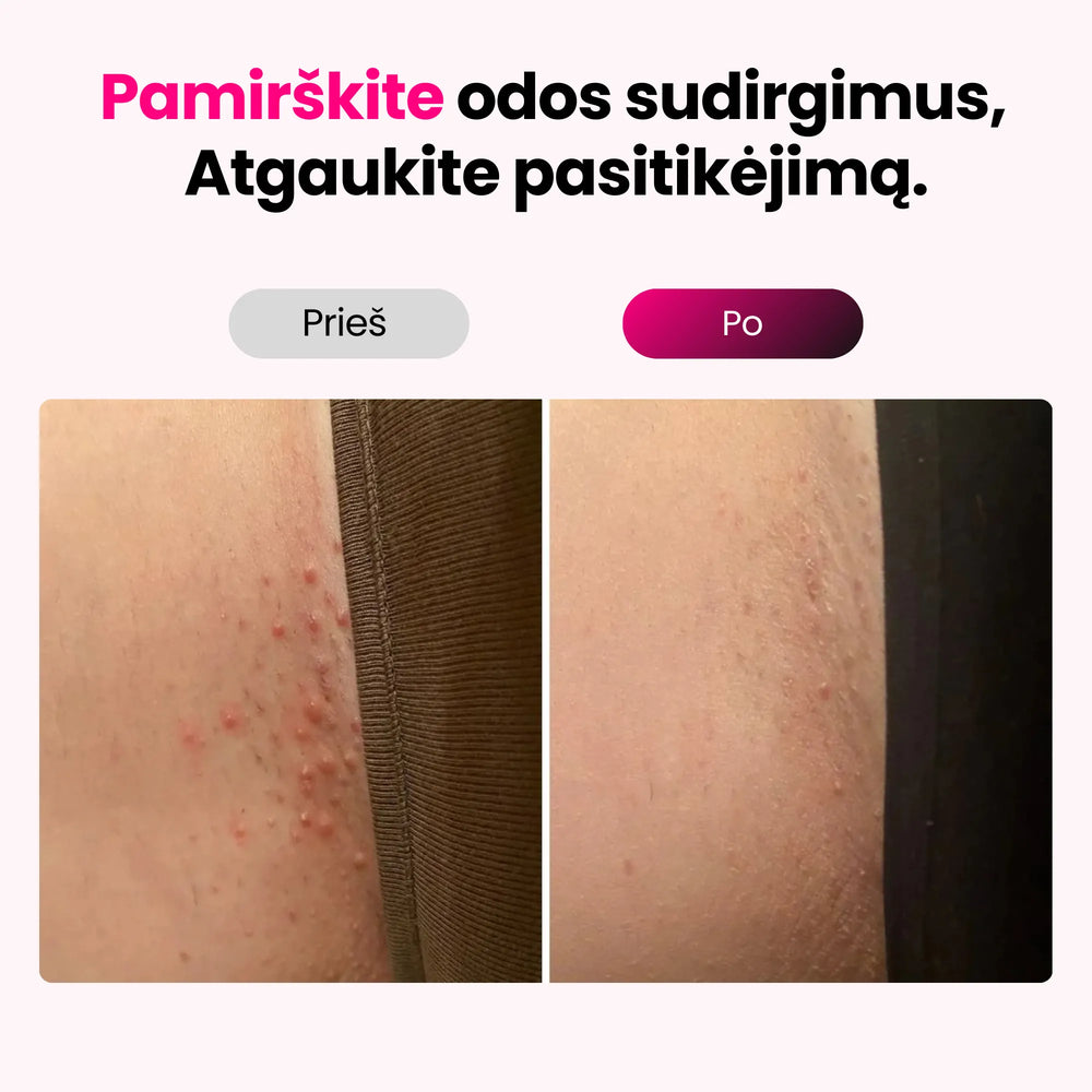 Elumi™ IPL plaukelių šalinimo rinkinys