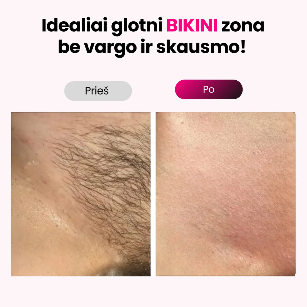 IPL Fotoepiliatorius